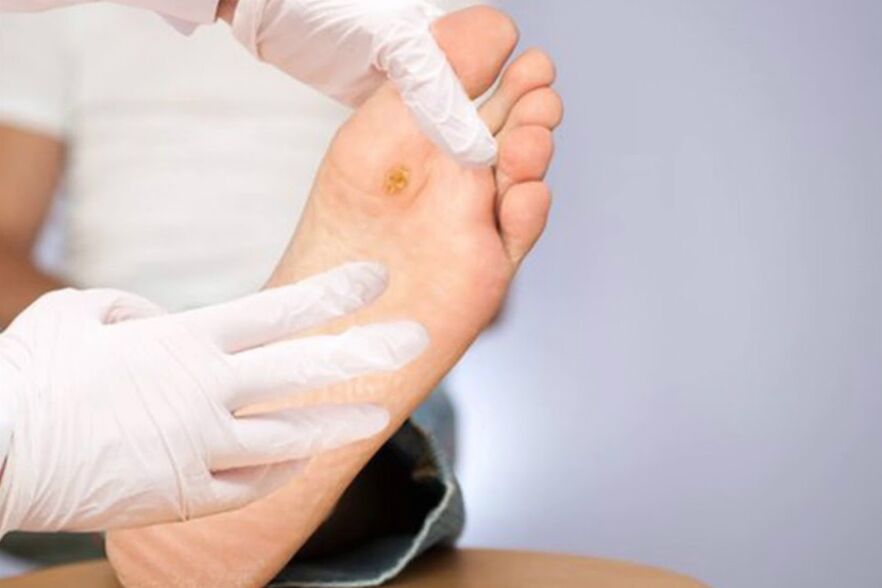 Piede diabetico - grave complicazione del diabete